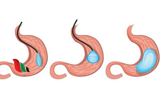 الدكتور عايض القحطاني كرمشة المعدة كم سعرها في الرياض