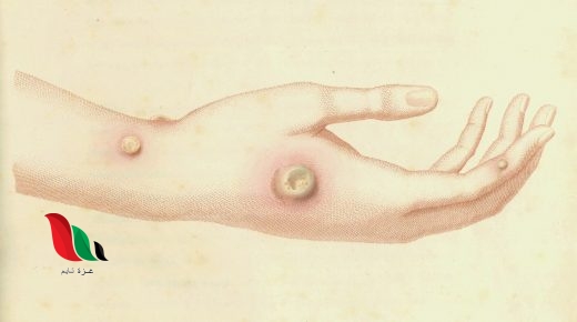 هل ينتقل جدري البقر للانسان عن طريق الحليب ؟