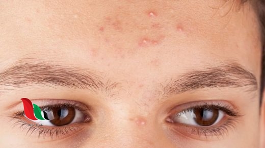 دراسة: ظهور البثور الصفراء على الجلد مؤشر على ارتفاع نسبة الكوليسترول