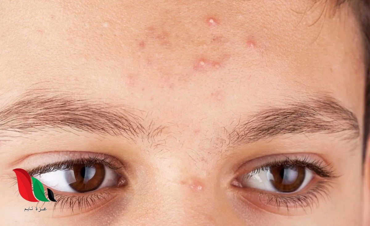 دراسة: ظهور البثور الصفراء على الجلد مؤشر على ارتفاع نسبة الكوليسترول