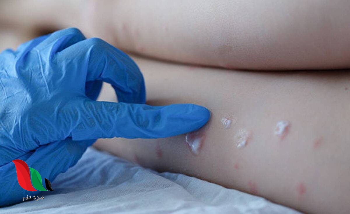 ما هو جدري القرود وما مدى خطورته؟