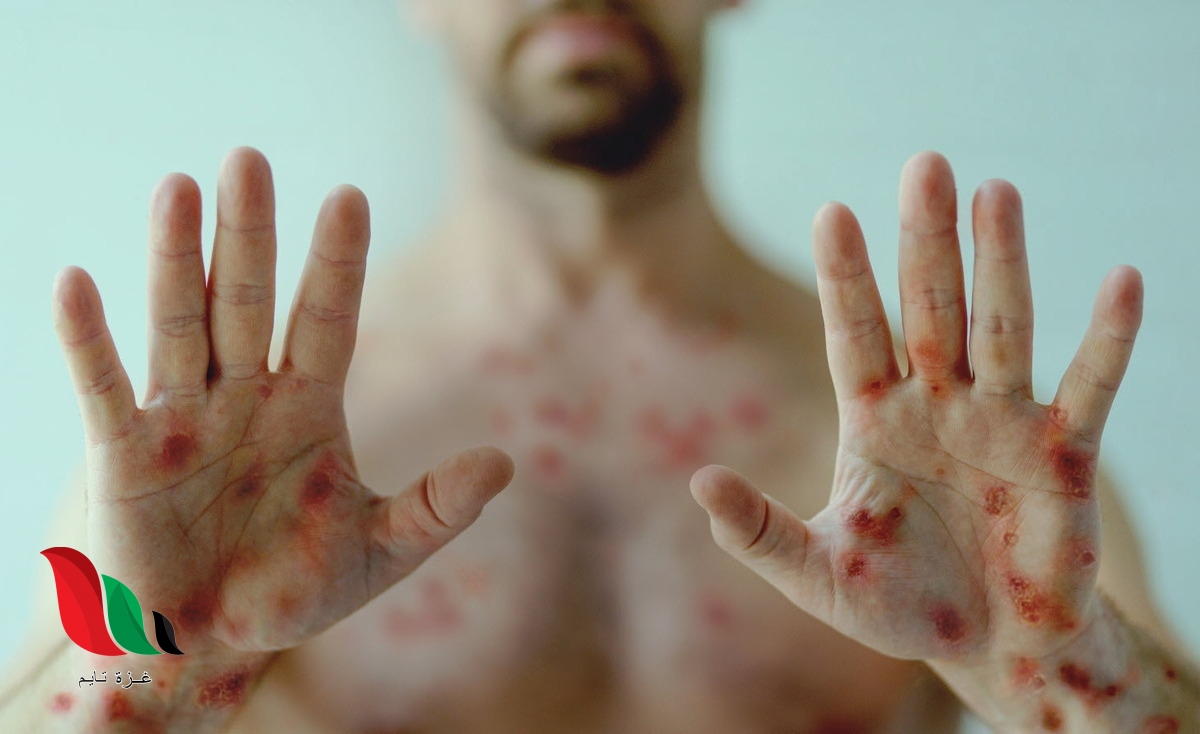 جدري القرود.. إلى أين؟