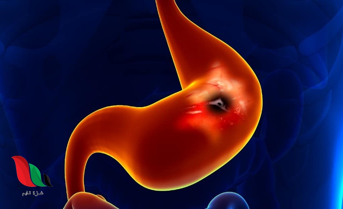 ما هو الجديد في علاج القرحة الهضمية؟