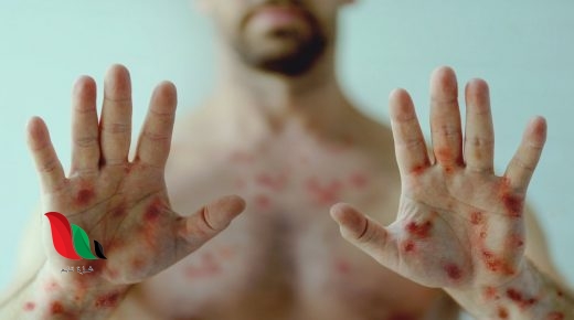 جدري القرود.. إلى أين؟