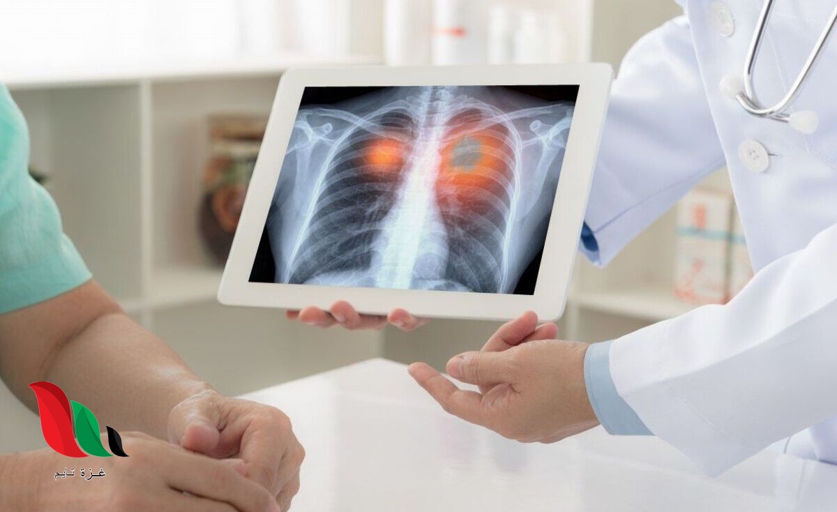 لماذا يصاب غير المدخنين بسرطان الرئة؟