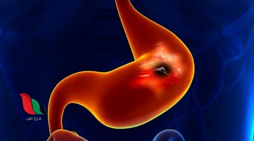 ما هو الجديد في علاج القرحة الهضمية؟