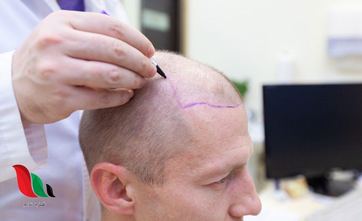 زراعة الشعر في السعودية 2022 2023 معلومات تفصيلية