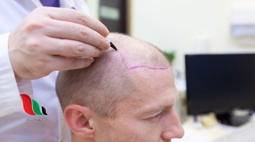 زراعة الشعر في السعودية 2022 2023 معلومات تفصيلية