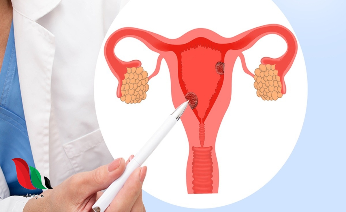 هل بطانة الرحم المهاجرة مرض خطير