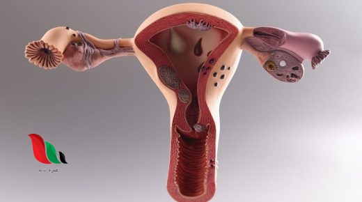 هل تكيس المبايض خطير ؟