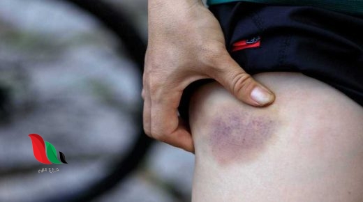 أسباب ظهور كدمات زرقاء في الجسم بدون سبب