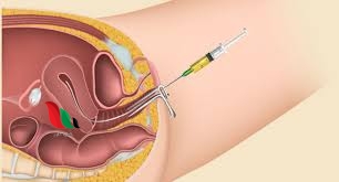 تجربتي مع التلقيح الصناعي بالتفصيل