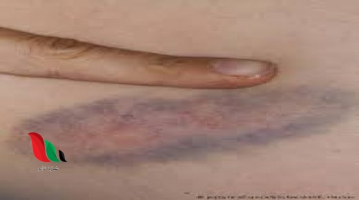 ظهور بقع زرقاء في الجسم عند النساء بدون سبب