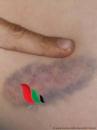 ظهور بقع زرقاء في الجسم عند النساء بدون سبب