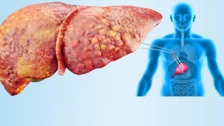 تحذيرات من تراكم دهون الكبد ومخاطره على الصحة العامة
