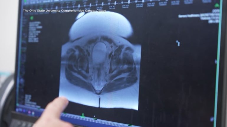 تقرير طبي جديد: توقعات بارتفاع حاد في حالات سرطان الكبد عالميًا بحلول عام 2050