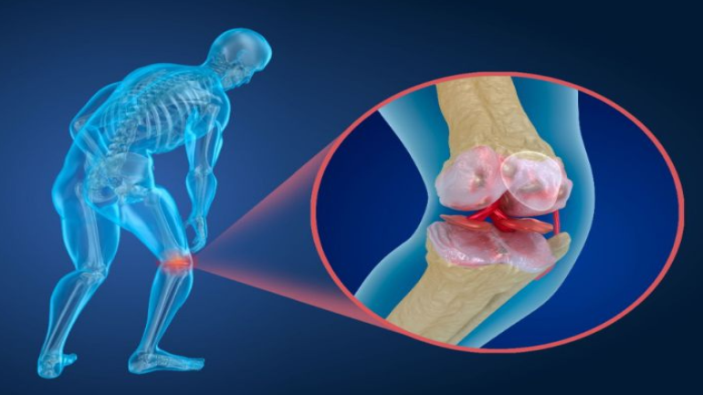 علاج لتخفيف ألم المفاصل الناتج عن خشونة الركبة