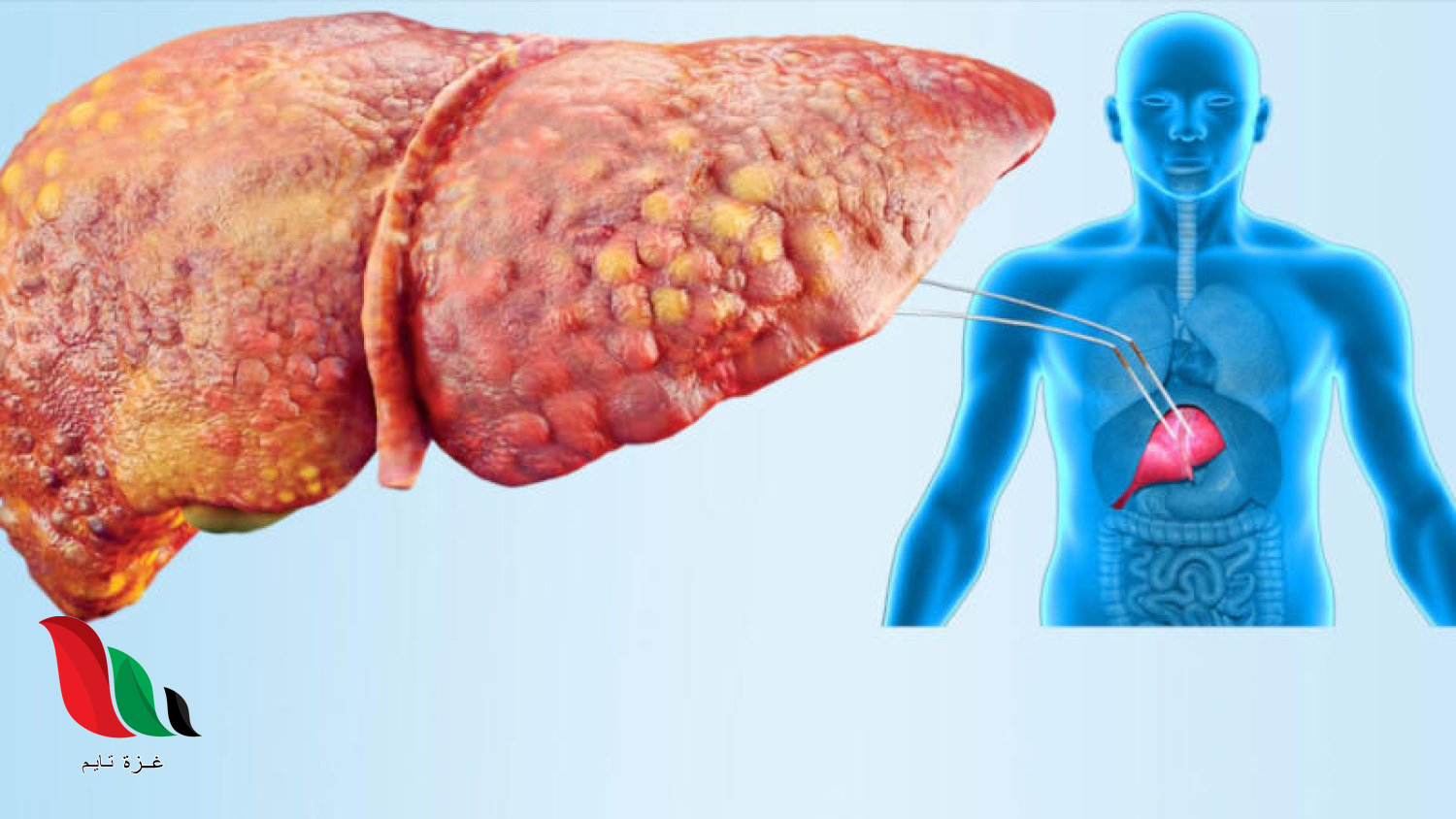 تحذيرات من تراكم دهون الكبد ومخاطره على الصحة العامة