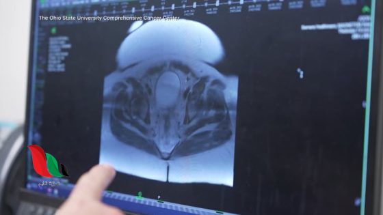 تقرير طبي جديد توقعات بارتفاع حاد في حالات سرطان الكبد عالميًا بحلول عام 2050