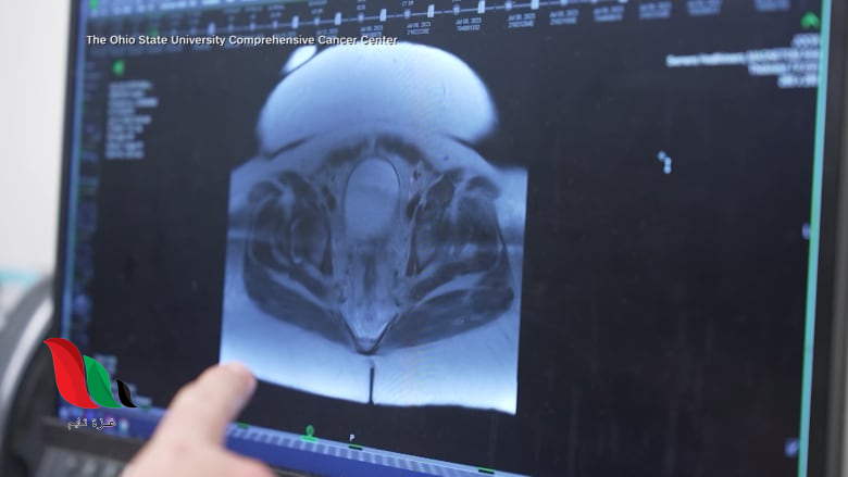 تقرير طبي جديد توقعات بارتفاع حاد في حالات سرطان الكبد عالميًا بحلول عام 2050