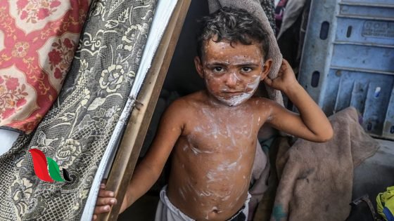 وسط انهيار المنظومة الصحية.. جدري الماء يتفشى في خيام نازحي غزة